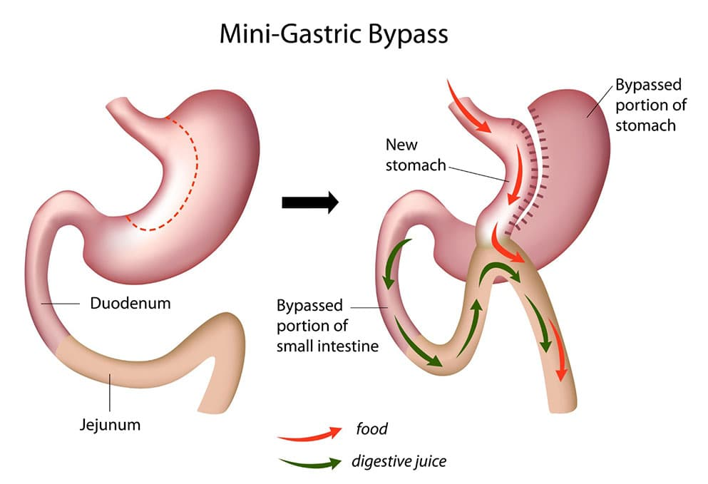 Gastric Bypass